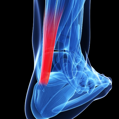 physical-therapy-clinic-Achilles-Tendinopathy-McCabe-and-Brady-Physical-Therapy-Ivyland-New-Britain-Warminster-PA