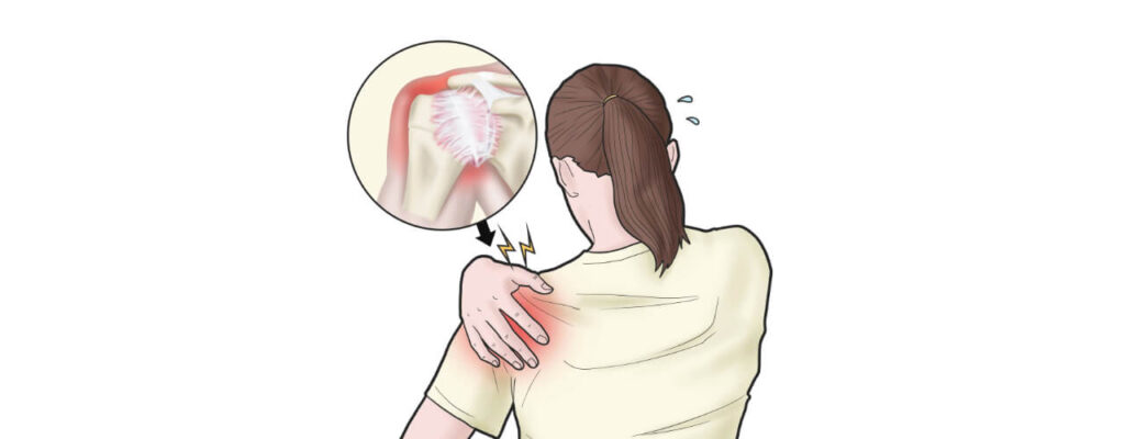 Frozen shoulder treatment